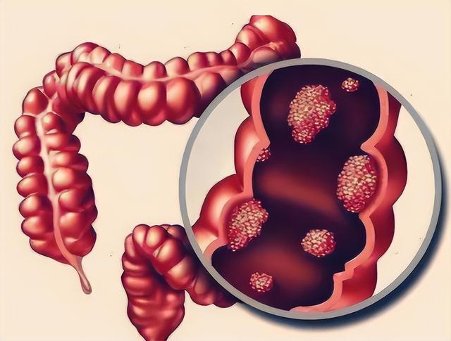 肠道里长了息肉，上厕所时会有3个提示，别等到中晚期了才发现