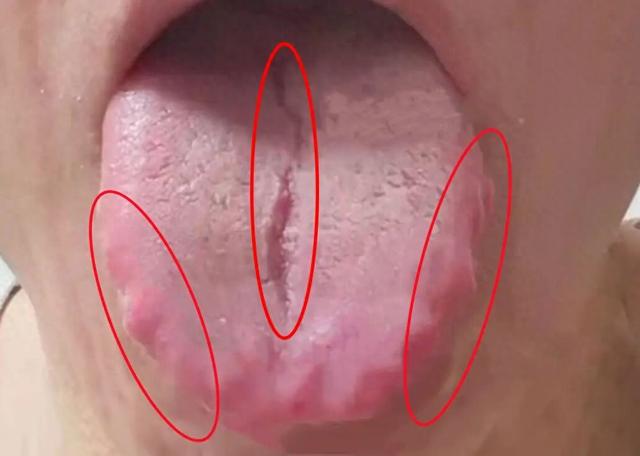 健脾祛湿药无效？揭秘齿痕舌、裂纹舌背后的真凶