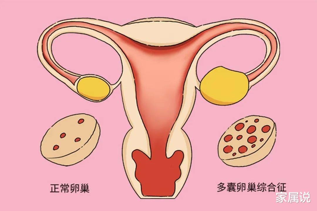 多囊卵巢综合征的危险因素有哪些？该如何治疗呢？