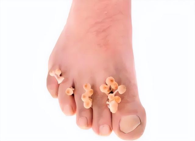 一个万能方：二妙丸，不但可以清热燥湿，还能治这4种病！