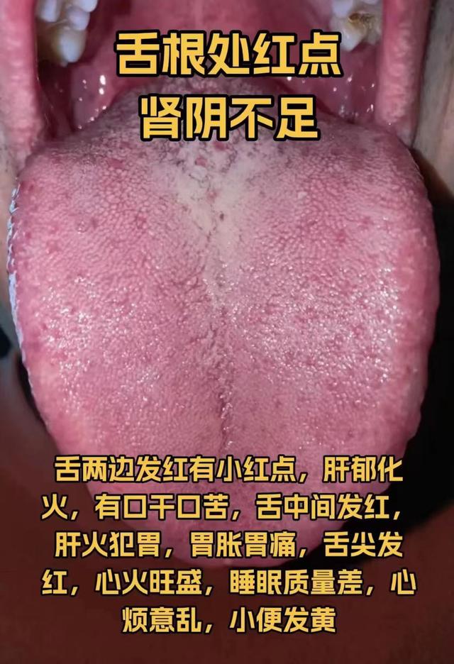 潘医生舌诊—实战分析：肾气不足，肾阳不足，肾阴不足