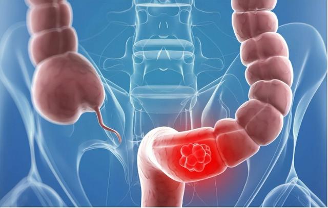 直肠癌看大便就知?提醒:上厕所时发现6个怪象,尽早做下肠镜