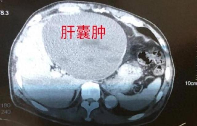 肝囊肿的克星来了，记住这些中药！