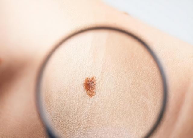 再三提醒：长在9个部位的痣，与癌症“密不可分”，及时处理
