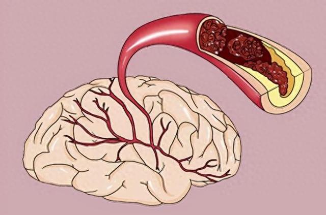 为什么中国脑梗越来越多,美国却在减少?医生:主要原因有3点