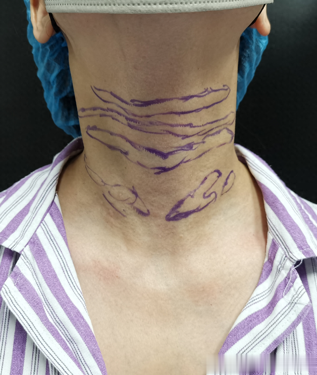 10年前打假美容针祛颈纹，结果脖子凸起鼓包，44岁女士来取出异物