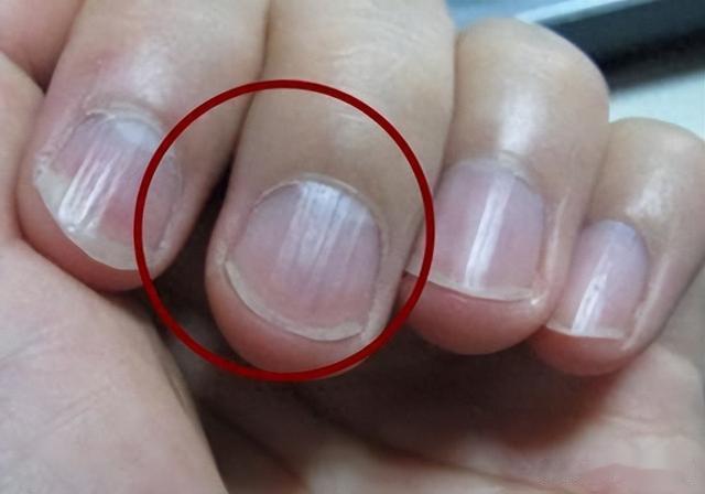 手脚发麻、指甲有竖纹、白发多？多半是肝血不足了