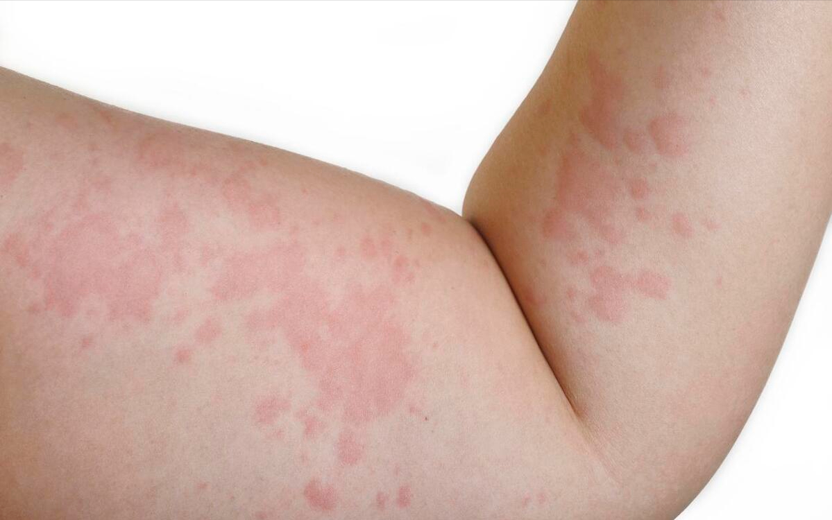 春季过敏高发，科学防护可预防，下面有你想了解的防护知识！