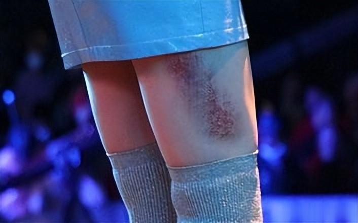 张靓颖摔下高台后续,被曝伤势严重,令人恶心的一幕还是发生了