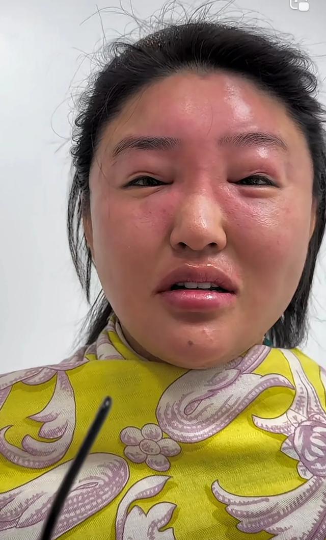 赵本山徒孙娇娇五一晒近照，全脸肿胀太吓人，网友：像猪头焖子！