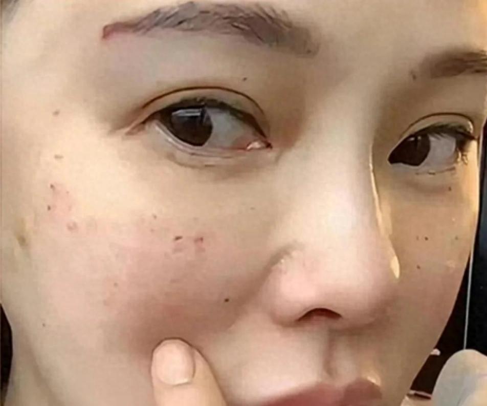 56岁伊能静晒满脸针孔照，直言抗衰痛到流泪：针扎进去时攥着拳头