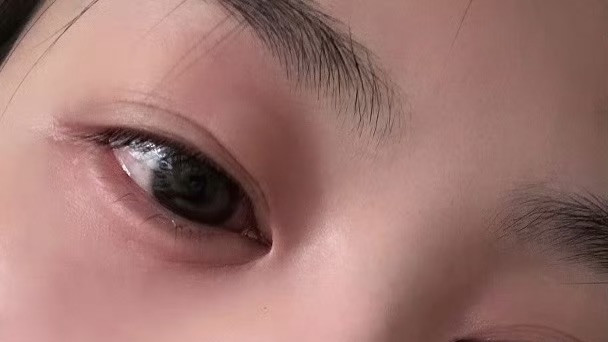 担心！TVB力捧小花自曝严重过敏，呼吸困难，眼睛肿成一条缝