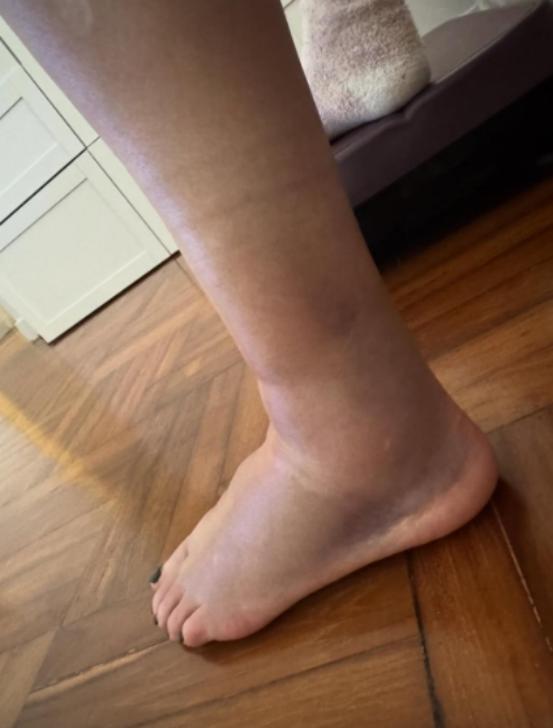 香港知名女星发生意外,左脚骨裂肿起来很高,曾与周润发闪婚闪离