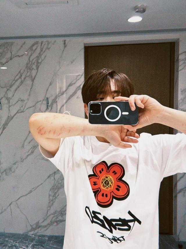 姜涛堕海 | 姜涛手部伤势曝光，两前臂伤疤逾20个：酷酷的手臂