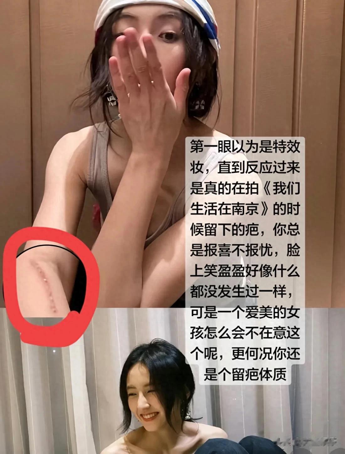 张子枫手臂伤疤长达十几厘米，胸口还有大片淤青，本人下场回应了