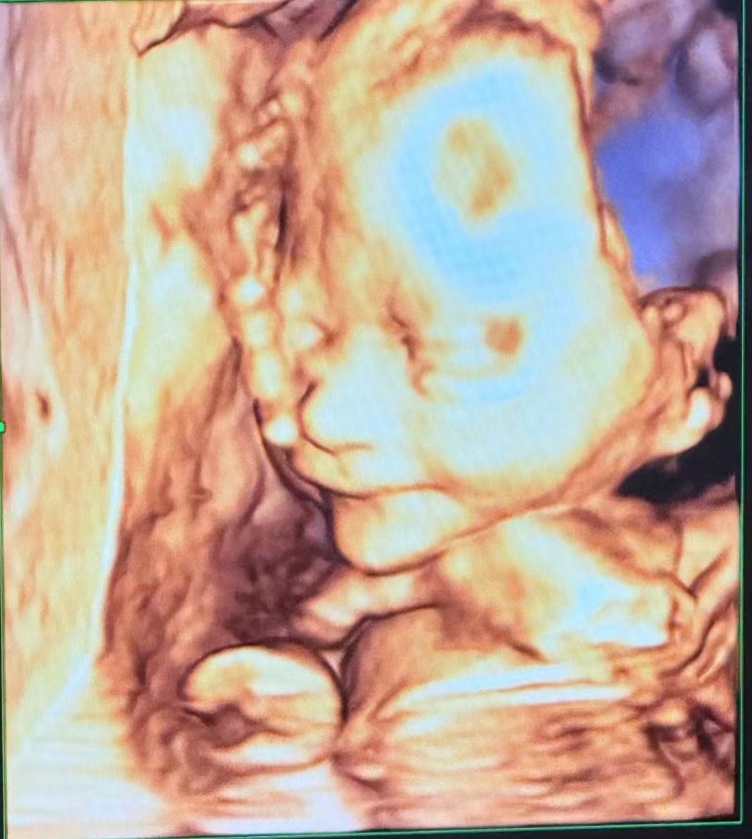 包贝尔妻子临近产期,包文婧八月孕肚圆润,面条子B超照真容曝光