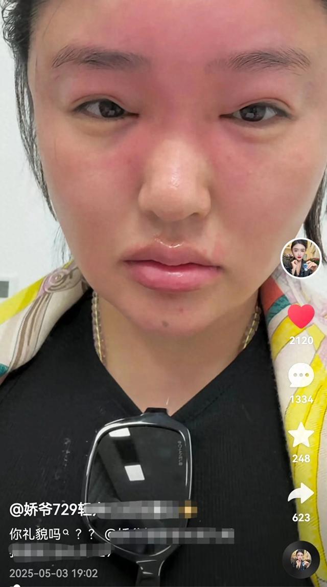 赵本山徒孙娇娇五一晒近照，全脸肿胀太吓人，网友：像猪头焖子！