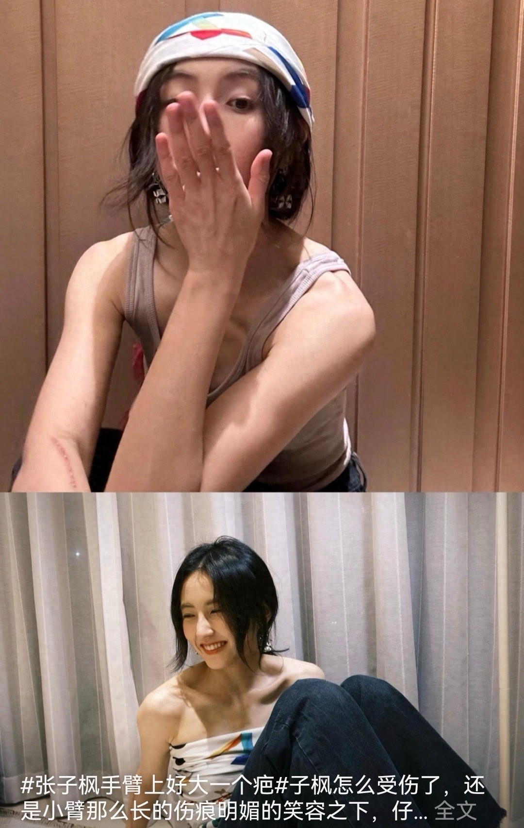 张子枫手臂10cm疤痕触目惊心！梁家辉心疼，她却笑称是勋章