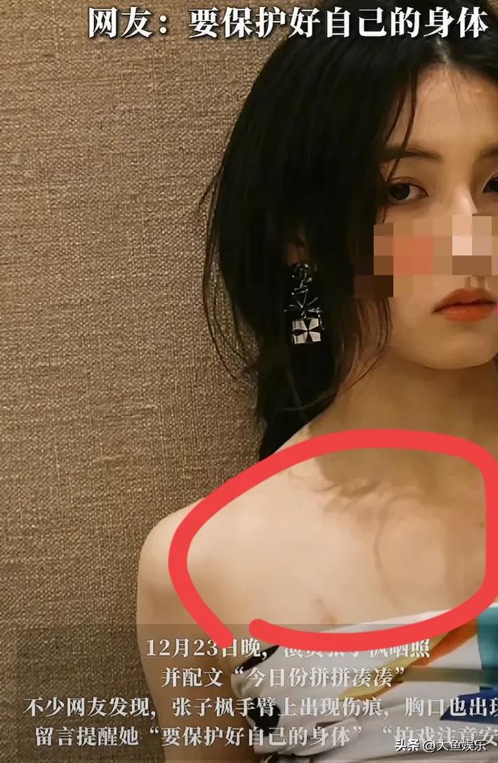 张子枫手臂伤疤长达十几厘米，胸口还有大片淤青，本人下场回应了