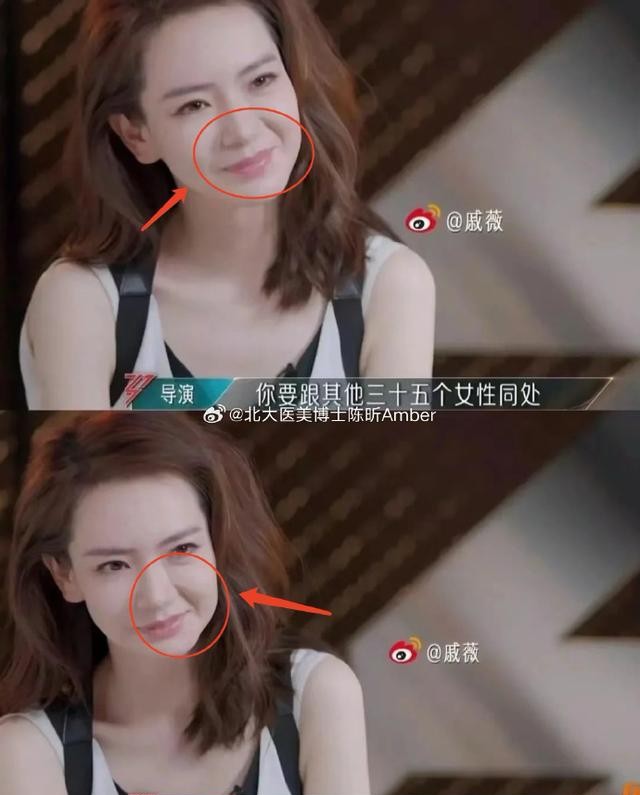 戚薇眼部状态引争议！被指撞脸刘玉玲，网友：眼角快扯到后脑勺了