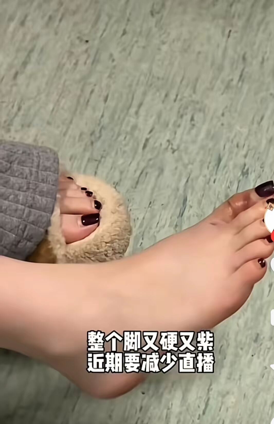 黄一鸣脚趾骨折住院，脚肿得像馒头！男友缺席陪伴，闪闪的话应验