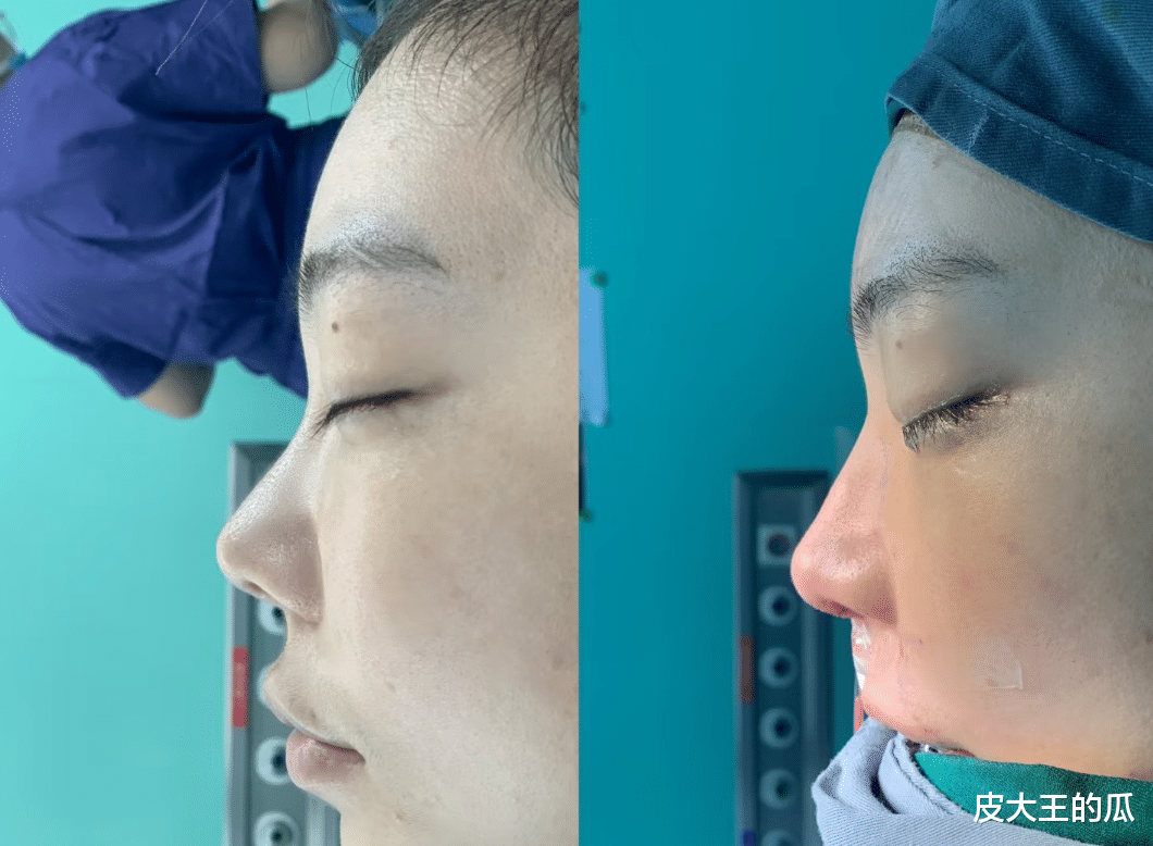 后悔自己十年前没做!刘飞儿“换鼻”成功,网友:做之前就像整的