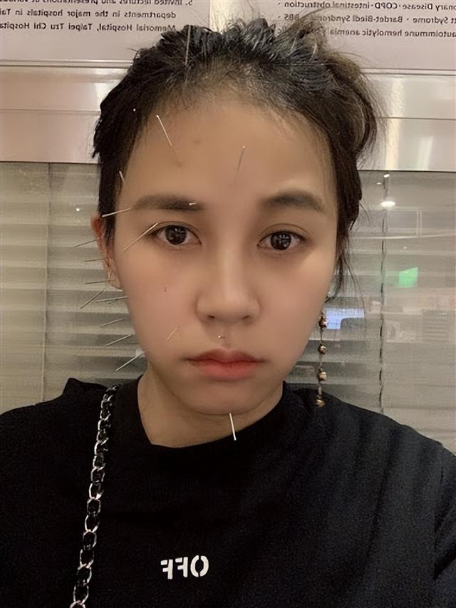 女星自曝与脑肿瘤抗争6年,术后竟患上面瘫:不敢出门不敢照镜子