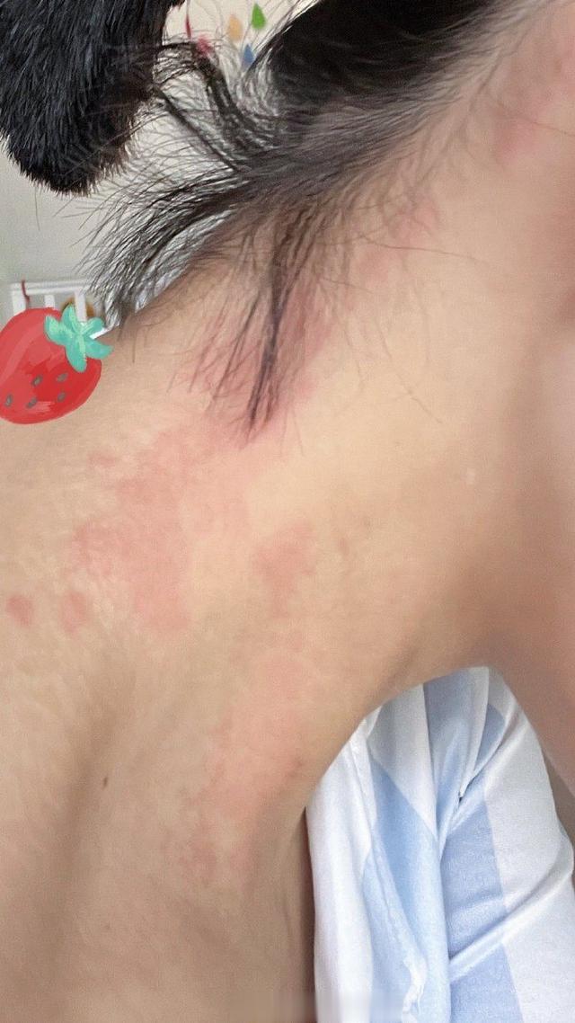 杜淳老婆打肉毒导致全身严重过敏,奇痒无比,直呼医美需谨慎