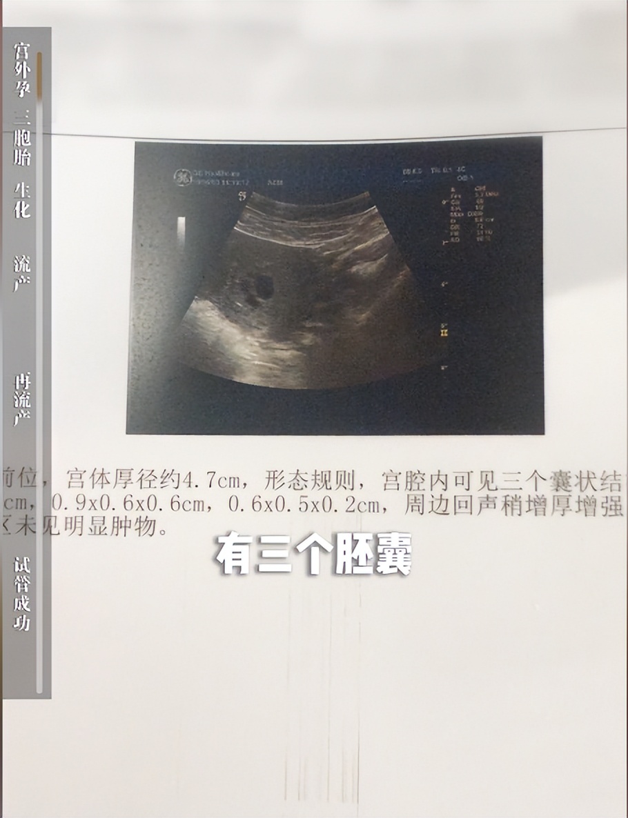 43岁女星梁晶晶备孕成功！曾被诊断卵巢早衰，流产5次没了7个孩子