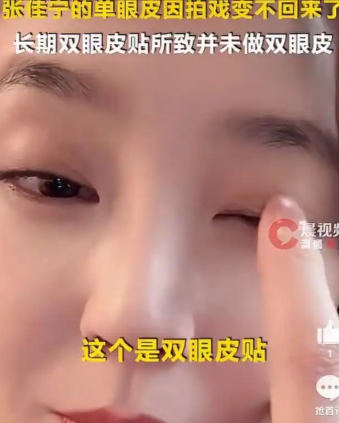 张佳宁冲上热搜，坦诚回应双眼皮争议