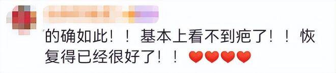 女演员杨蓉晒面部烫伤恢复照，疤痕已基本消退，此前称如果留疤也将接纳它